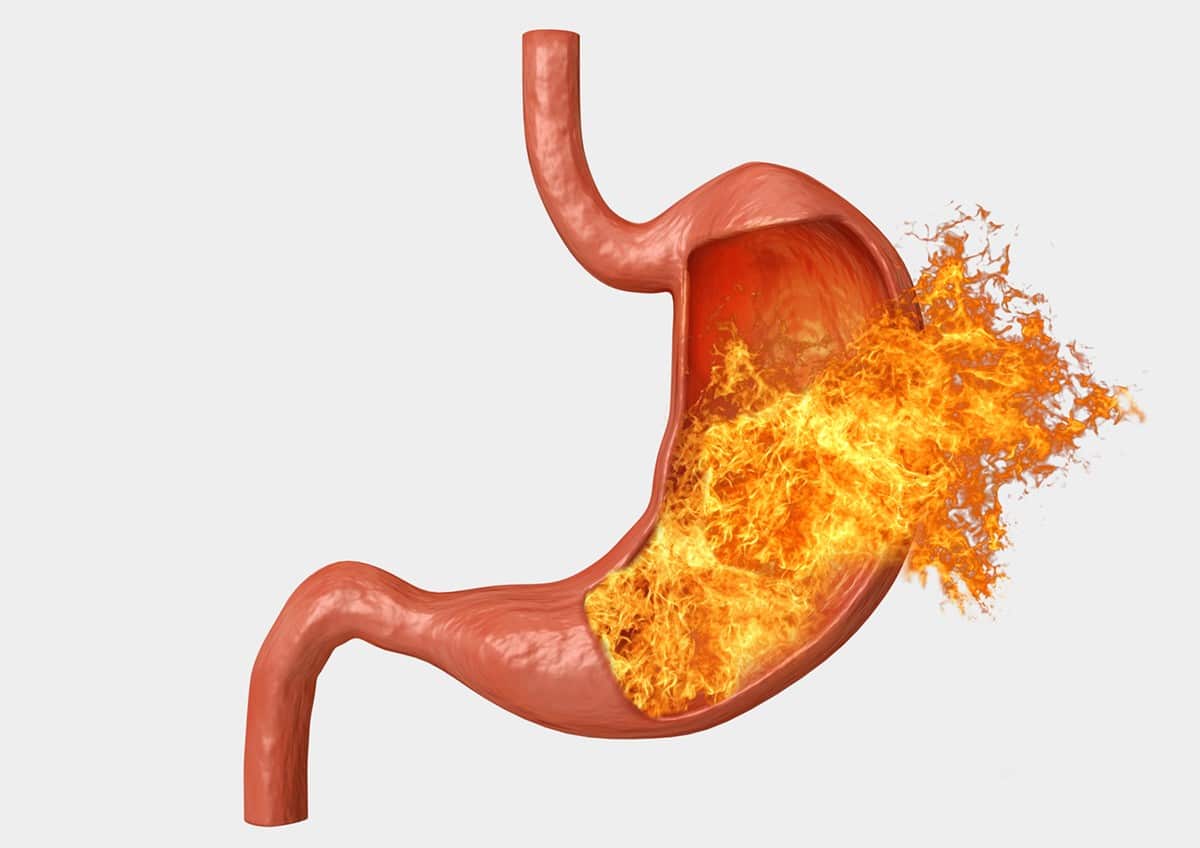 Acid Reflux